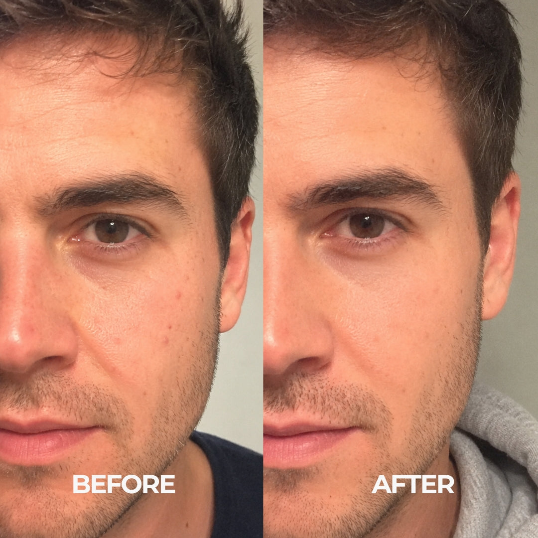 Red Light Therapy Mask